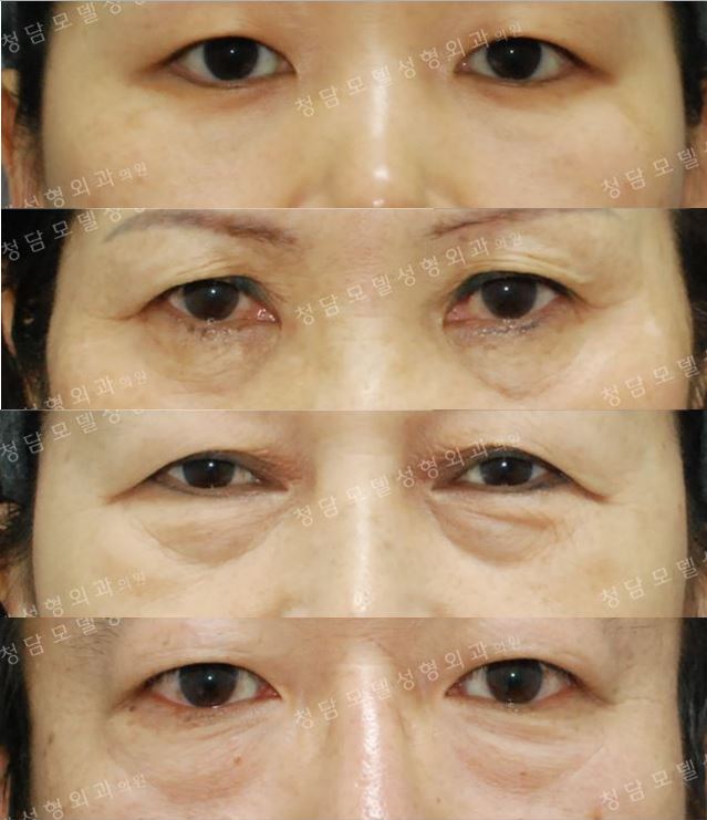[Dr.김치선 칼럼] 눈밑이 불룩하다면… 지방재배치와 안륜근현수를 이용한 하안검 성형술